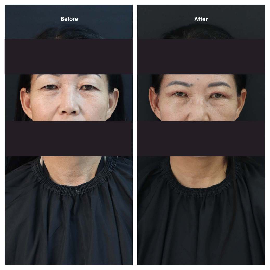 Eyelid Surgery KOQ10